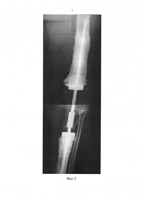 Спейсер - Устройство для лечения больных с глубокой перипротезной инфекцией